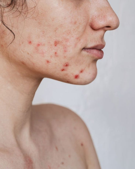 Prime Skin Analysis - Acne Edition - Skin Prime Lab